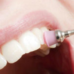 Detartrasi: perché avere denti bianchi significa godere di ottima salute