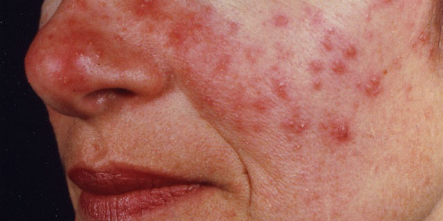 Acne rosacea sul viso