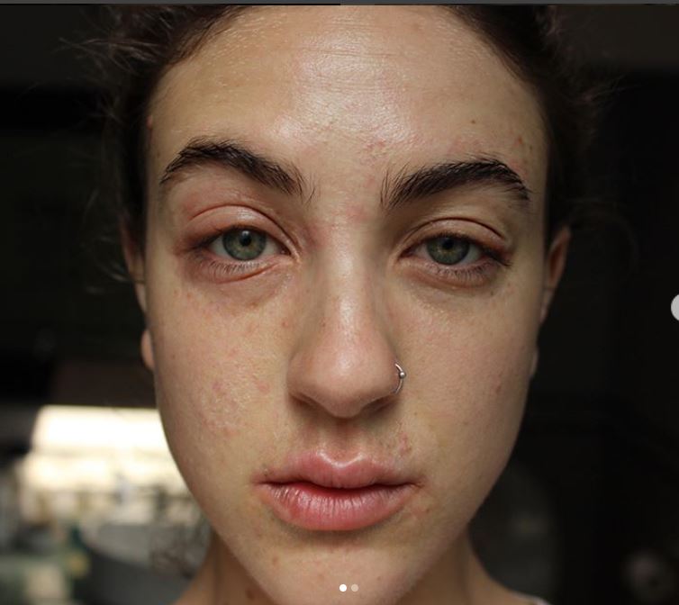 Ciena Rae Nelson: "Questa sono io, con la mia psoriasi, e non mi vergogno"
