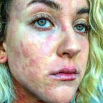 Ciena Rae Nelson: "Questa sono io, con la mia psoriasi, e non mi vergogno"