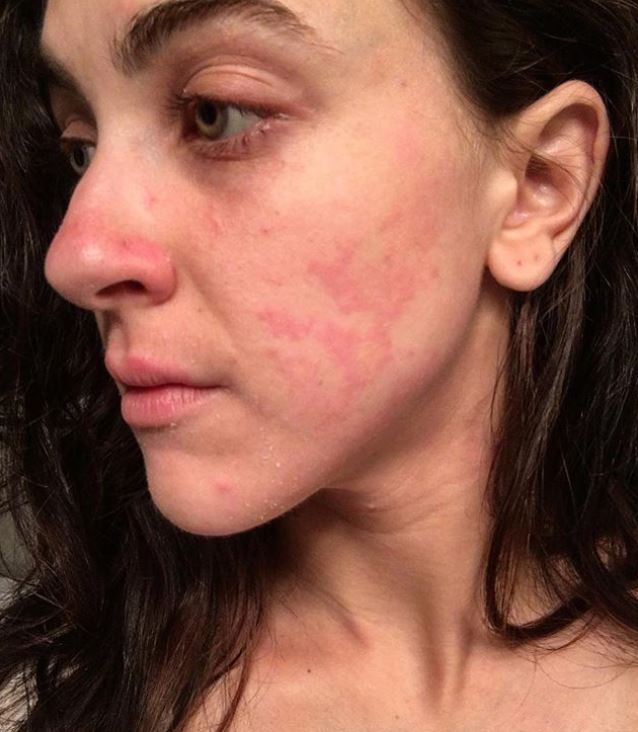 Ciena Rae Nelson: "Questa sono io, con la mia psoriasi, e non mi vergogno"