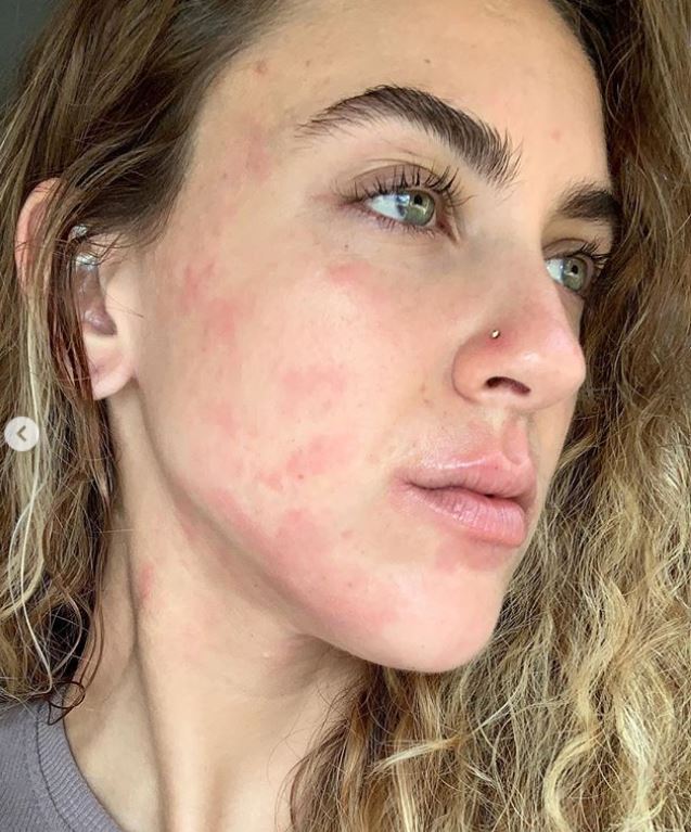 Ciena Rae Nelson: "Questa sono io, con la mia psoriasi, e non mi vergogno"