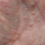 La disidrosi alle mani e ai piedi, lo specchio dello stress