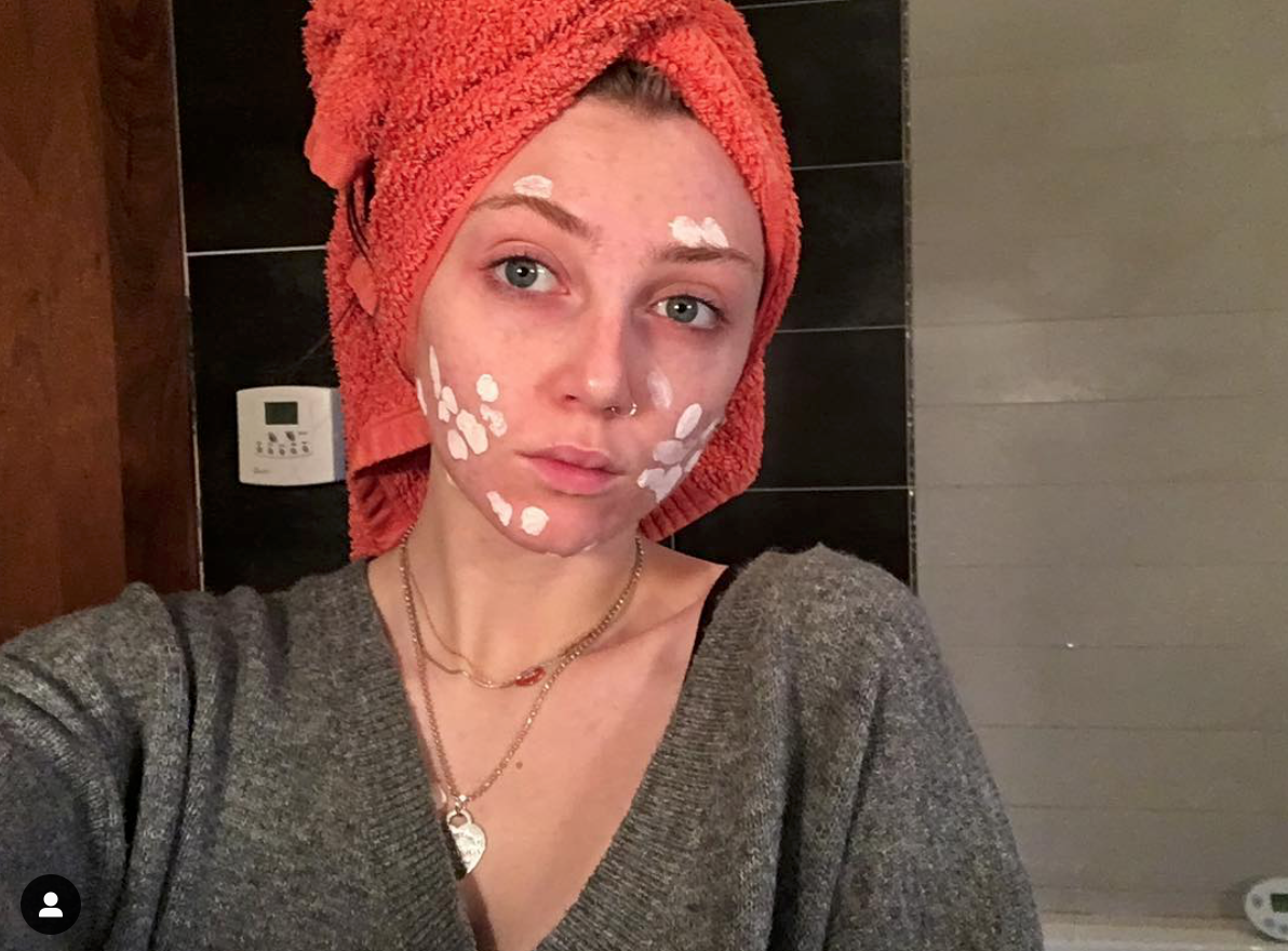 "L'acne non ci impedisce di essere belle"... o influencer come Louisa Northcote