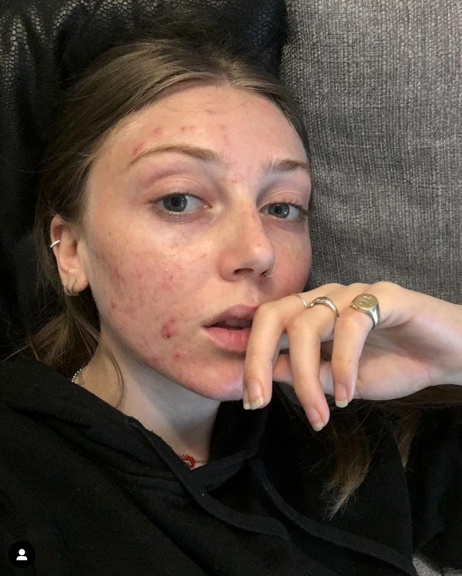 "L'acne non ci impedisce di essere belle"... o influencer come Louisa Northcote