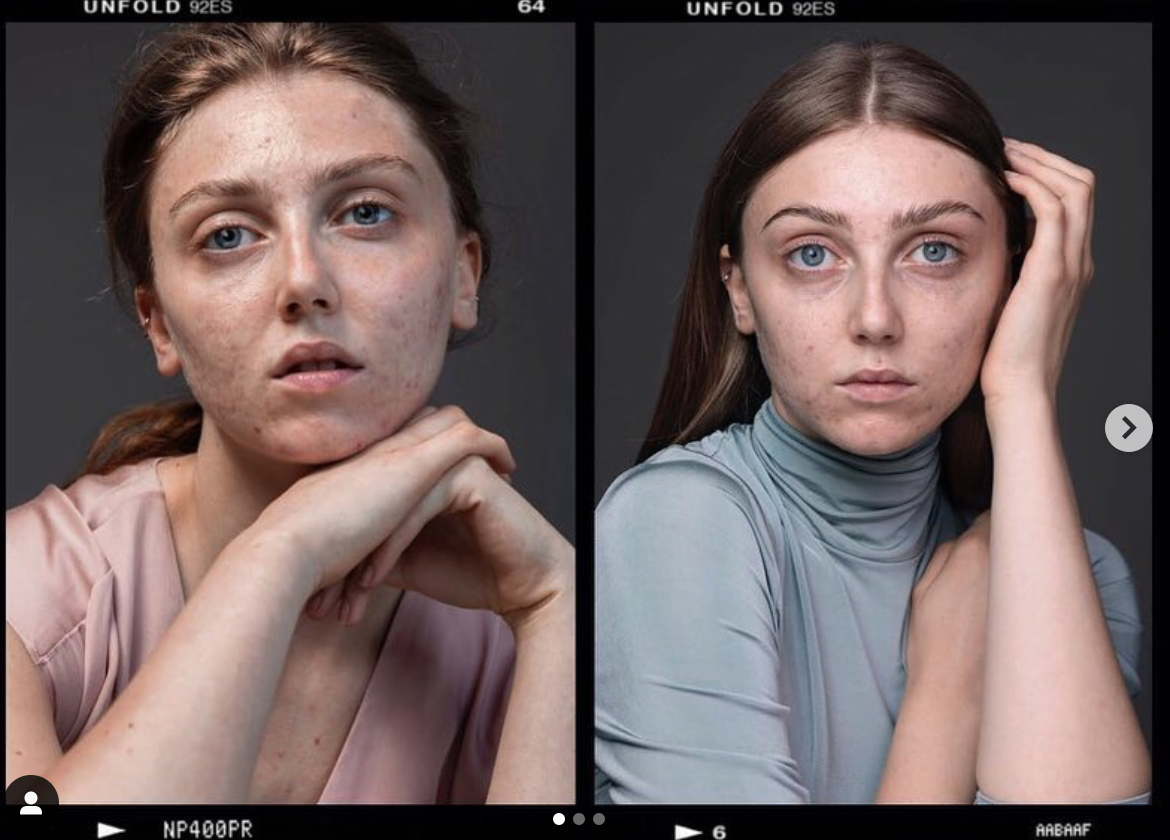 "L'acne non ci impedisce di essere belle"... o influencer come Louisa Northcote