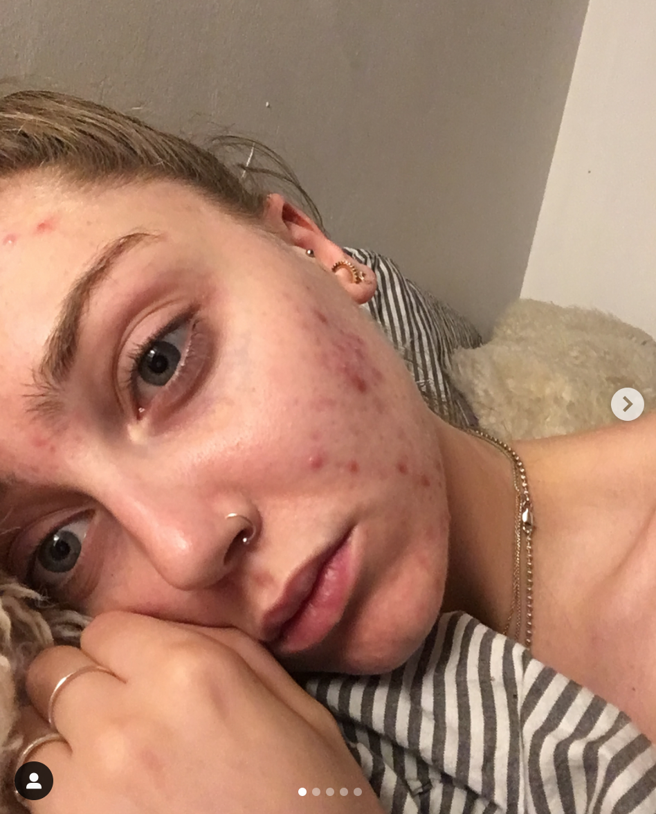 "L'acne non ci impedisce di essere belle"... o influencer come Louisa Northcote