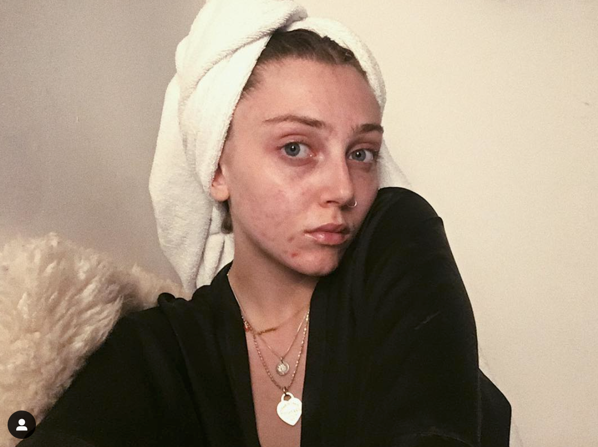"L'acne non ci impedisce di essere belle"... o influencer come Louisa Northcote