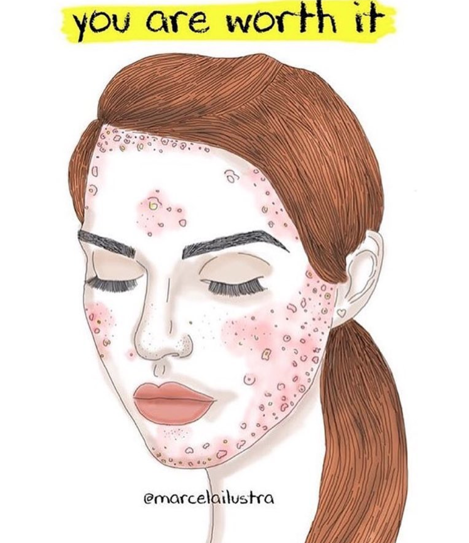 "L'acne non ci impedisce di essere belle"... o influencer come Louisa Northcote