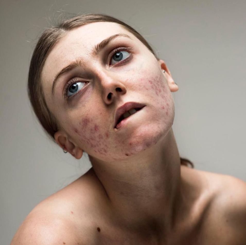"L'acne non ci impedisce di essere belle"... o influencer come Louisa Northcote