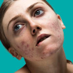 "L'acne non ci impedisce di essere belle"... o influencer come Louisa Northcote