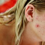 L'acne cistica: come trattarla per non avere cicatrici