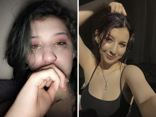 6 foto di teenager che mostrano la rinascita dalla malattia mentale grazie alle cure