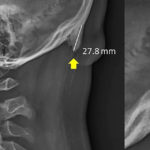 Quelle corna ossee che ci stanno crescendo sotto il cranio: colpa del cellulare?