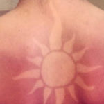 Quella moda pericolosa del “Sunburn Tattoo” e perché fa molto male