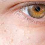 Milia, quegli antiestetici "granelli" sul viso che si possono curare
