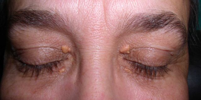 xantelasma
