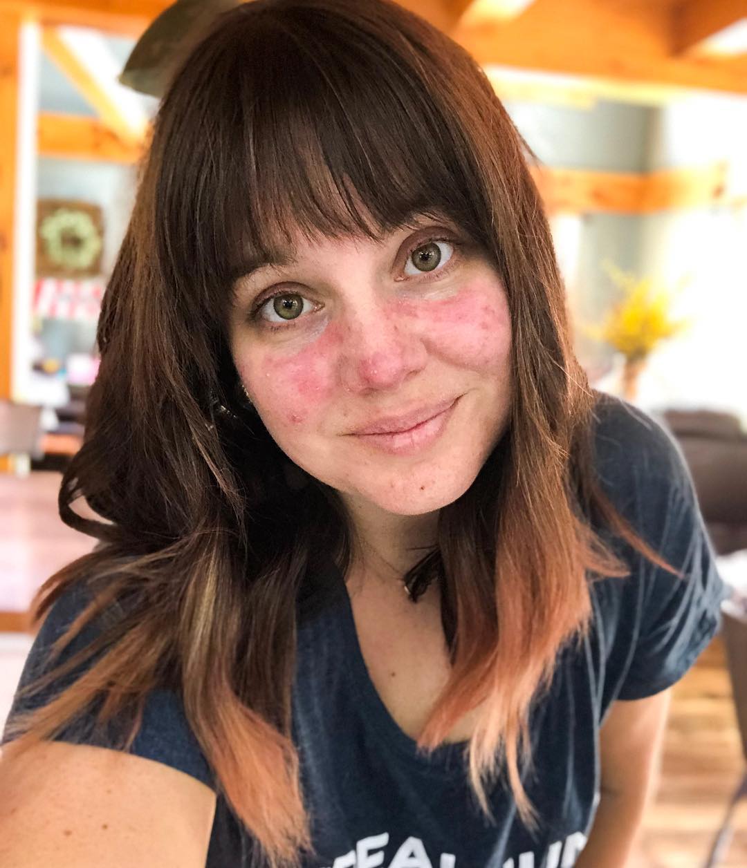 Rosacea senza filtri: cos'è, 7 storie e perché non è una generica "dermatite"