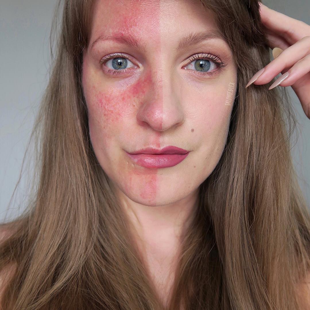 Rosacea senza filtri: cos'è, 7 storie e perché non è una generica "dermatite"