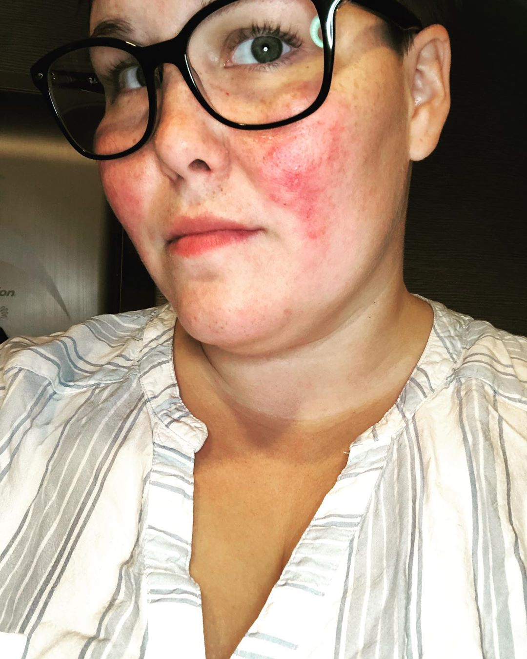 Rosacea senza filtri: cos'è, 7 storie e perché non è una generica "dermatite"