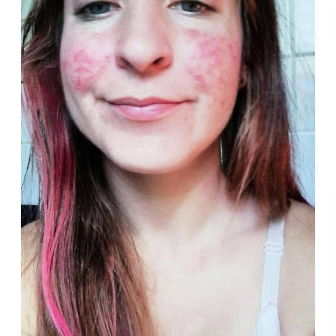 Rosacea senza filtri: cos'è, 7 storie e perché non è una generica "dermatite"