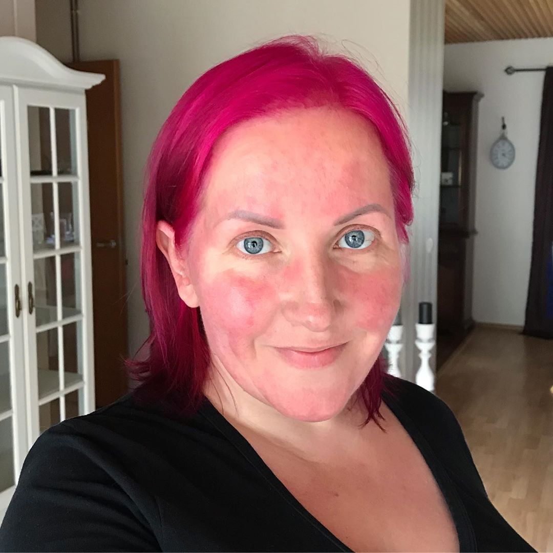 Rosacea senza filtri: cos'è, 7 storie e perché non è una generica "dermatite"