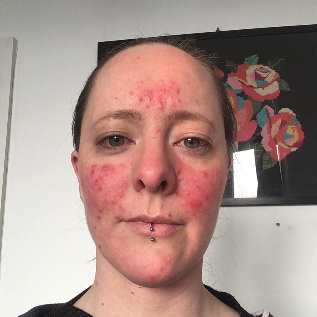 Rosacea senza filtri: cos'è, 7 storie e perché non è una generica "dermatite"
