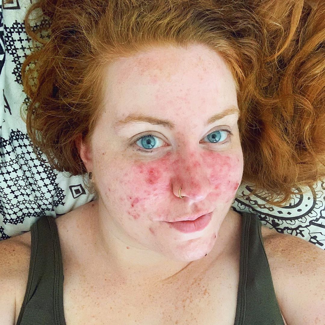 Rosacea senza filtri: cos'è, 7 storie e perché non è una generica "dermatite"