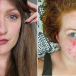 Rosacea senza filtri: cos'è, 7 storie e perché non è una generica "dermatite"