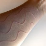 Dermografismo: quando la pelle ci parla (e come rispondere)