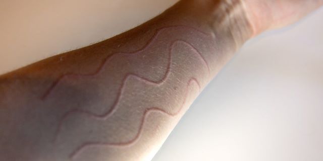 Dermografismo: quando la pelle ci parla (e come rispondere)