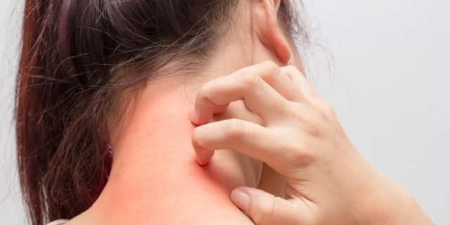 Intertrigine: cos'è e come si cura l'infiammazione "da sfregamento" Intertrigine: cos'è e come si cura l'infiammazione "da sfregamento"