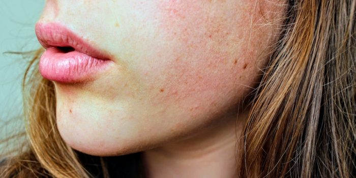 Anidrosi Cause E Cure Per L assenza Di Sudore Roba Da Donne