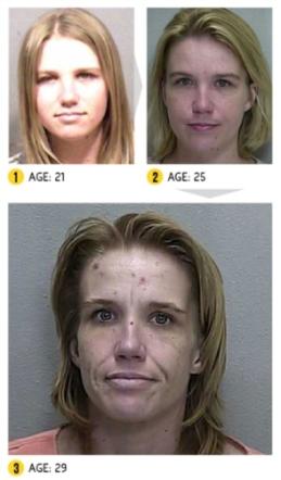 I Terribili Effetti della Droga sul Nostro Corpo: le Foto Shock