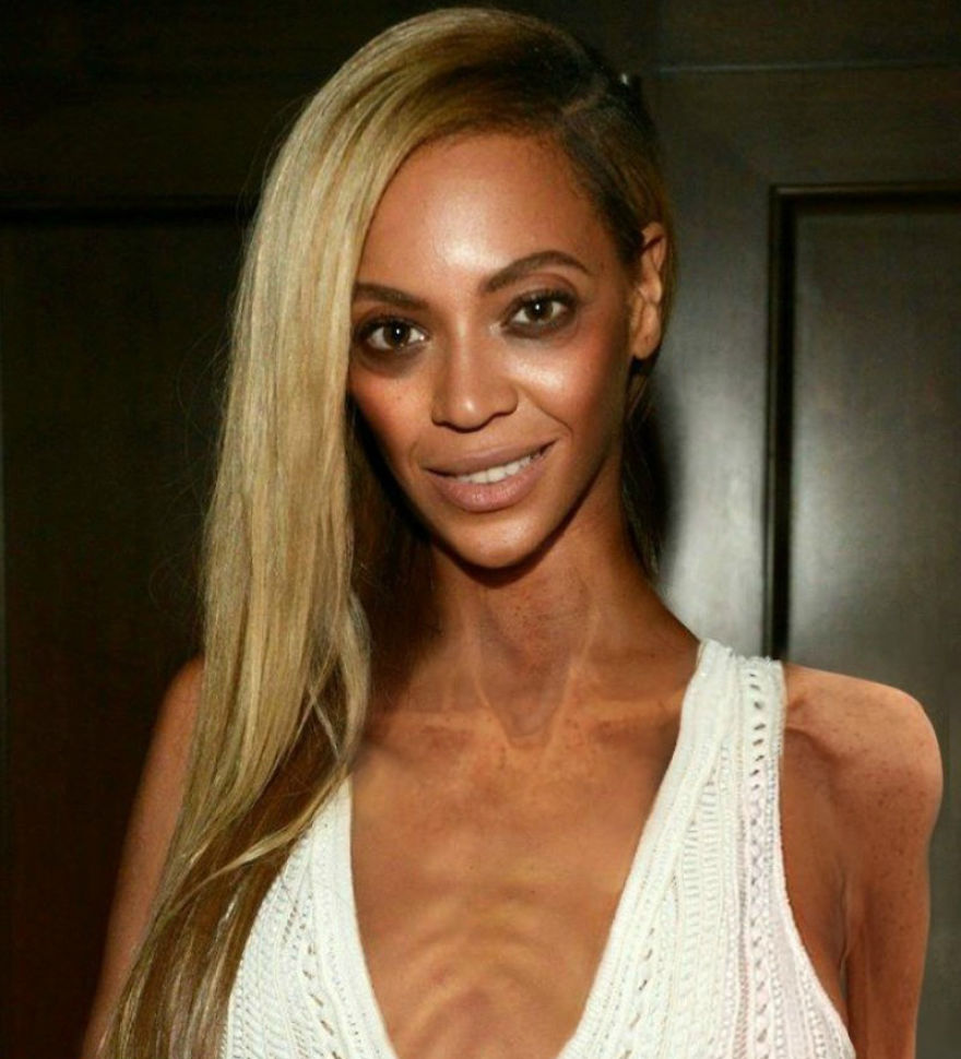 Anorexic Celebrities Contest: Come Sarebbero 14 Star Se Soffrissero di Anoressia