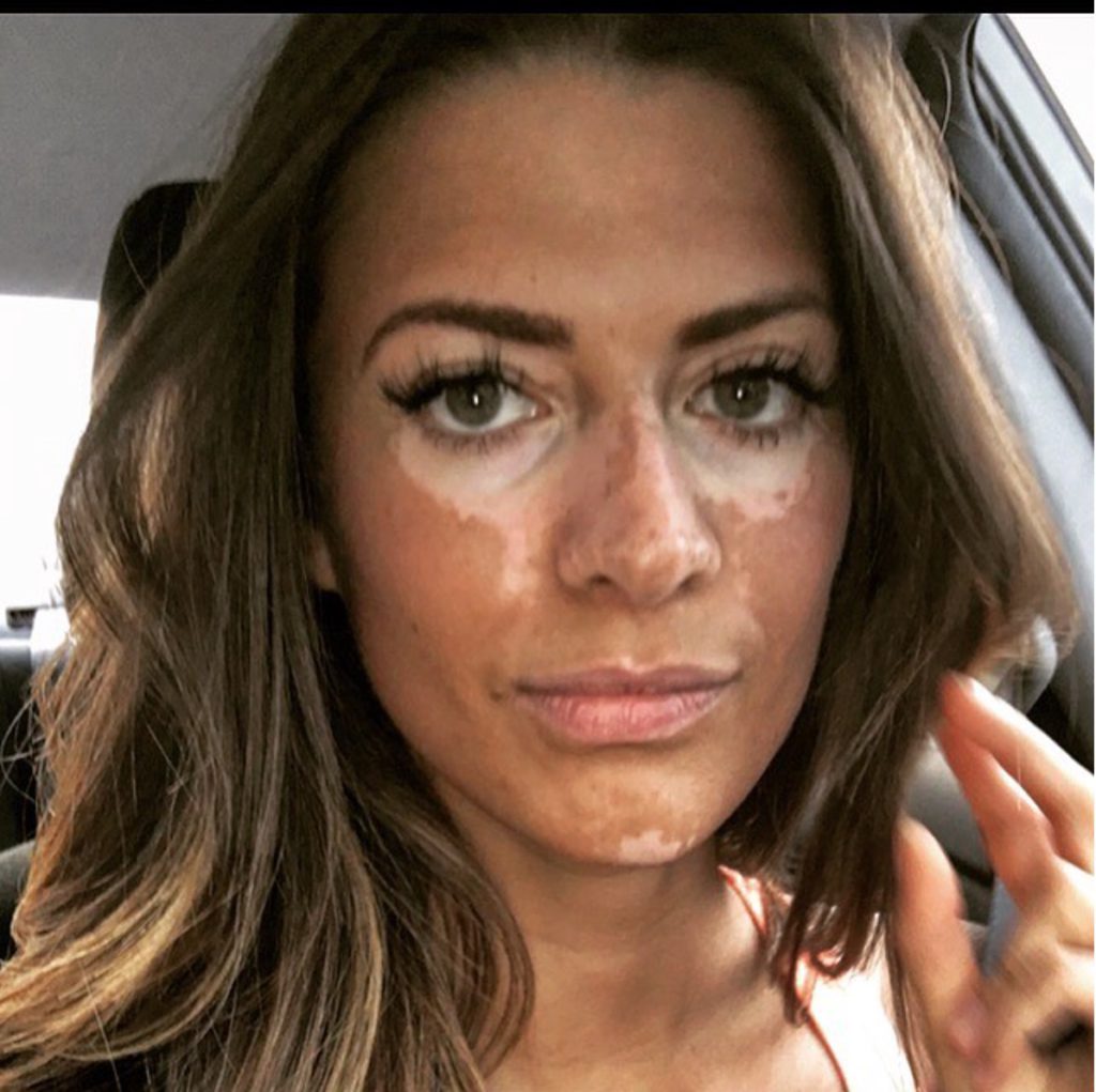 Modella malata di vitiligine: ecco le sue foto al naturale e parole che vale la pena leggere