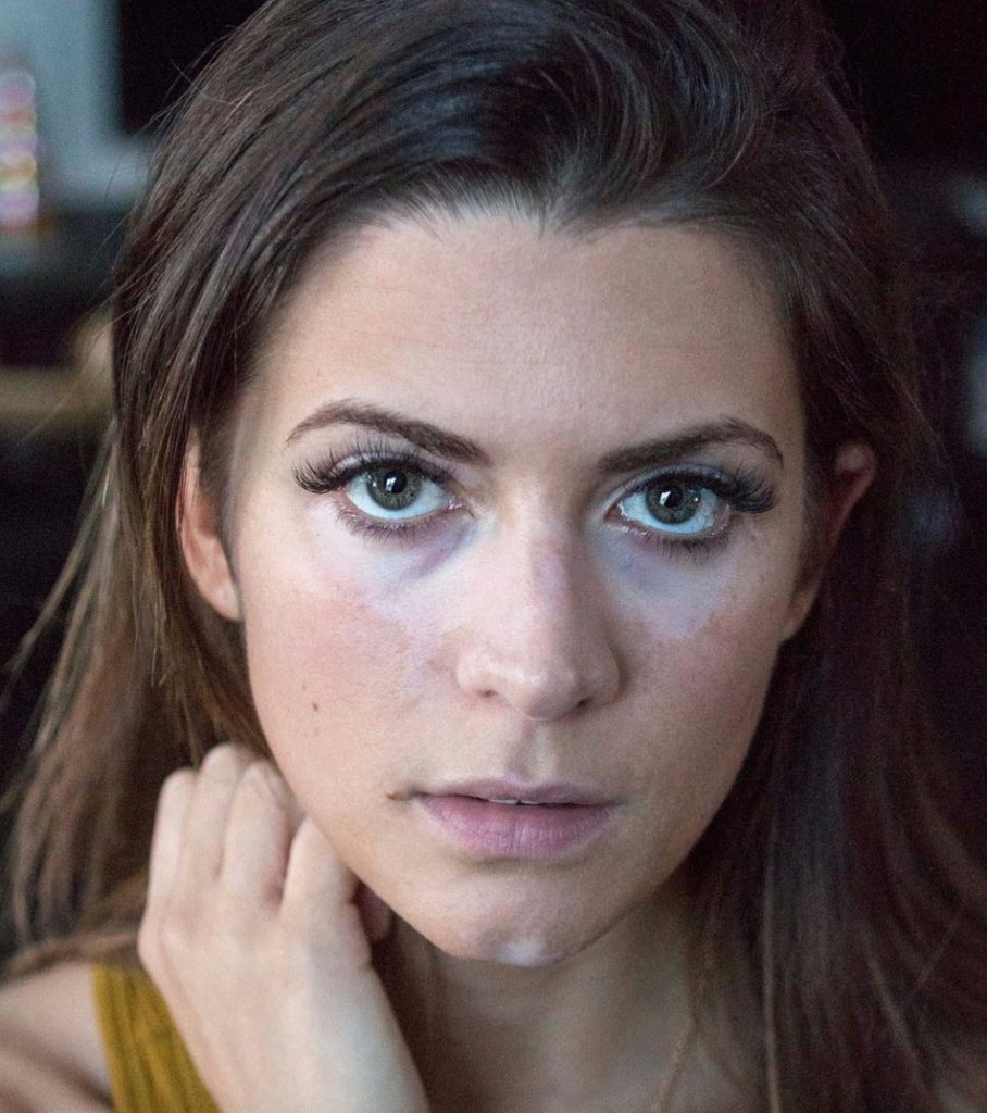 Modella malata di vitiligine: ecco le sue foto al naturale e parole che vale la pena leggere