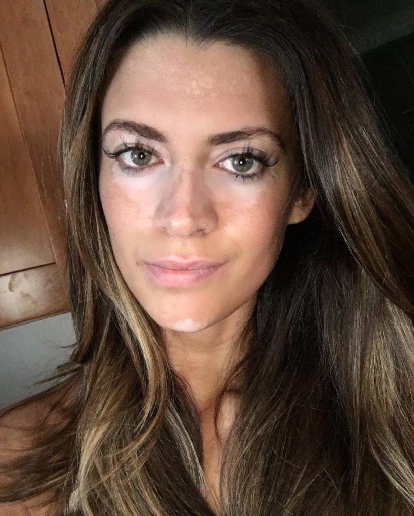 Modella malata di vitiligine: ecco le sue foto al naturale e parole che vale la pena leggere