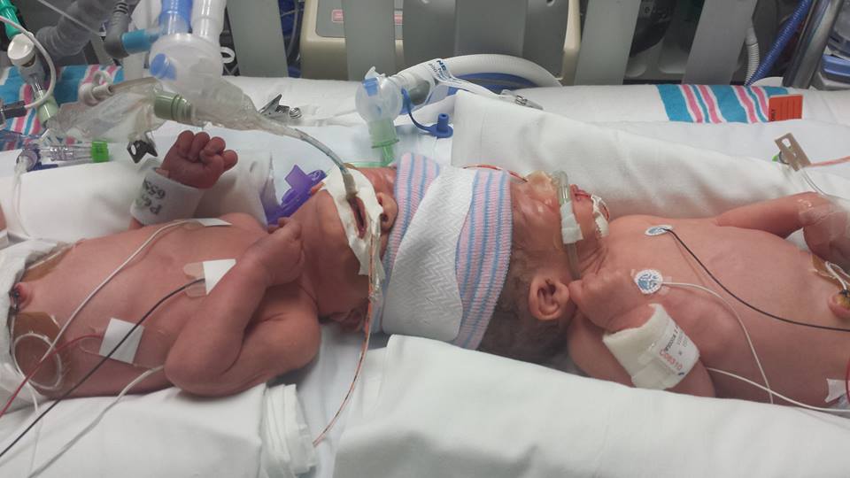 27 ore di intervento per separare i gemellini siamesi: l'emozione dei piccoli e di mamma e papà quando si rivedono per la prima volta in 12 bellissime foto
