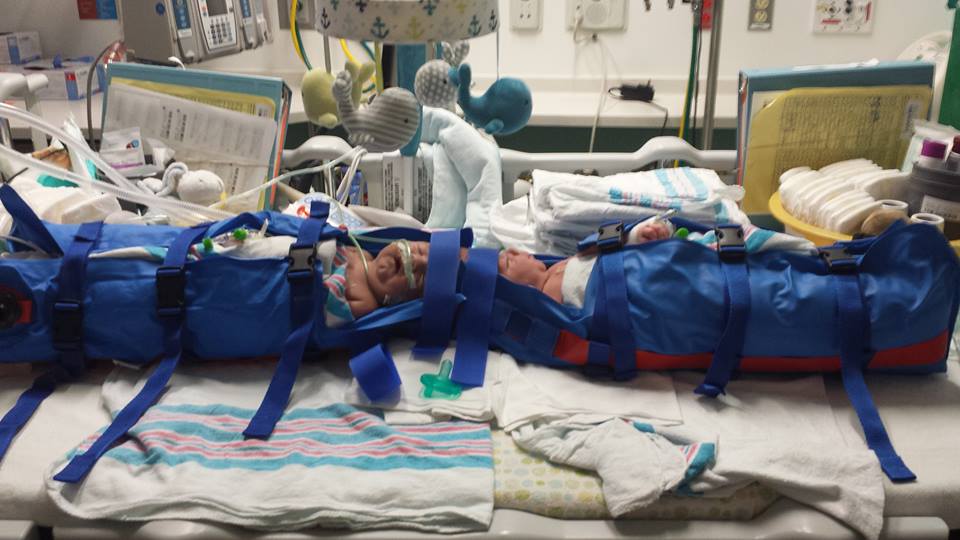 27 ore di intervento per separare i gemellini siamesi: l'emozione dei piccoli e di mamma e papà quando si rivedono per la prima volta in 12 bellissime foto