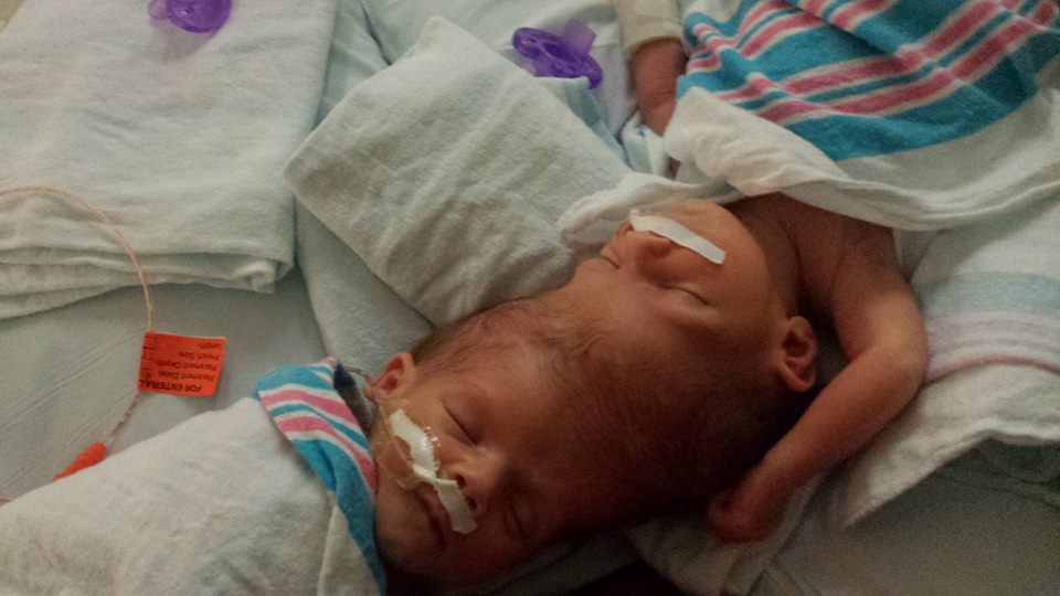 27 ore di intervento per separare i gemellini siamesi: l'emozione dei piccoli e di mamma e papà quando si rivedono per la prima volta in 12 bellissime foto