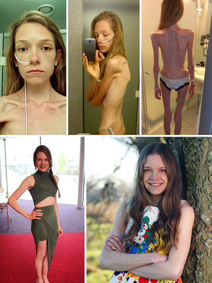 Rinascere: 12 foto prima e dopo l'anoressia