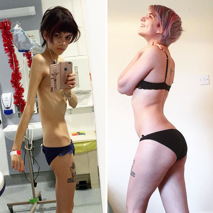 Rinascere: 12 foto prima e dopo l'anoressia