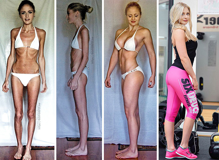 Rinascere: 12 foto prima e dopo l'anoressia