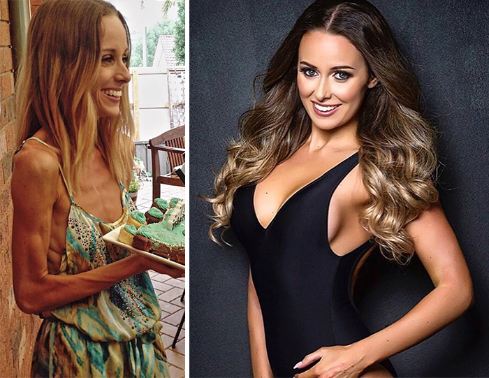 Rinascere: 12 foto prima e dopo l'anoressia