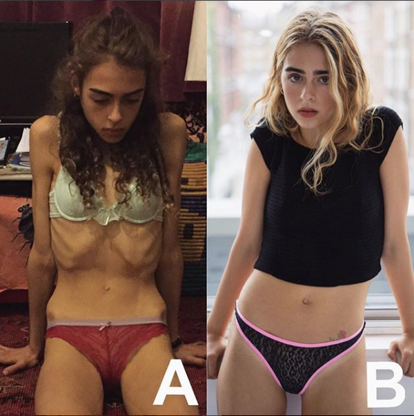 Rinascere: 12 foto prima e dopo l'anoressia