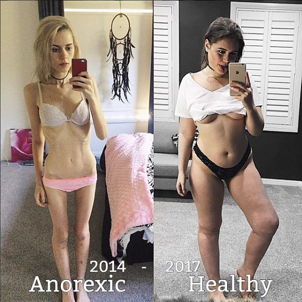 Rinascere: 12 foto prima e dopo l'anoressia