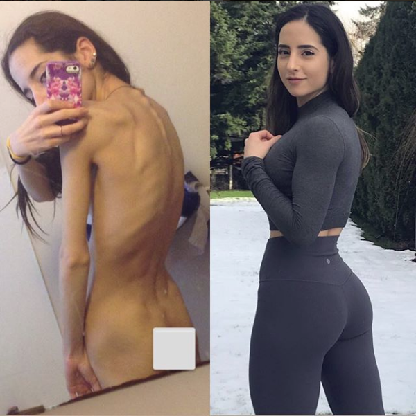 Rinascere: 12 foto prima e dopo l'anoressia