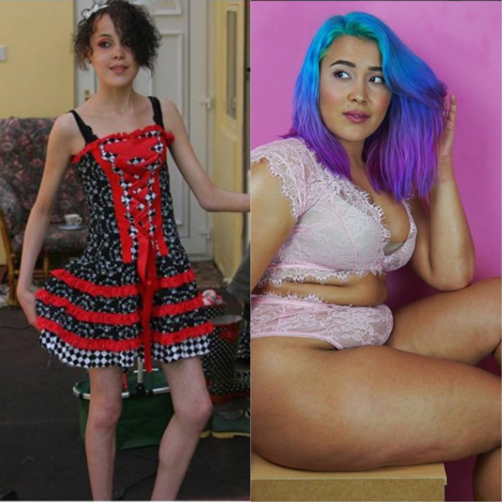 Rinascere: 12 foto prima e dopo l'anoressia