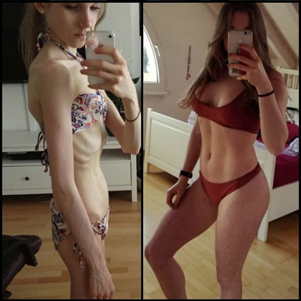 Rinascere: 12 foto prima e dopo l'anoressia